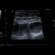 Crohn's disease, small bowel obstruction, ileus: US - Ultrasound